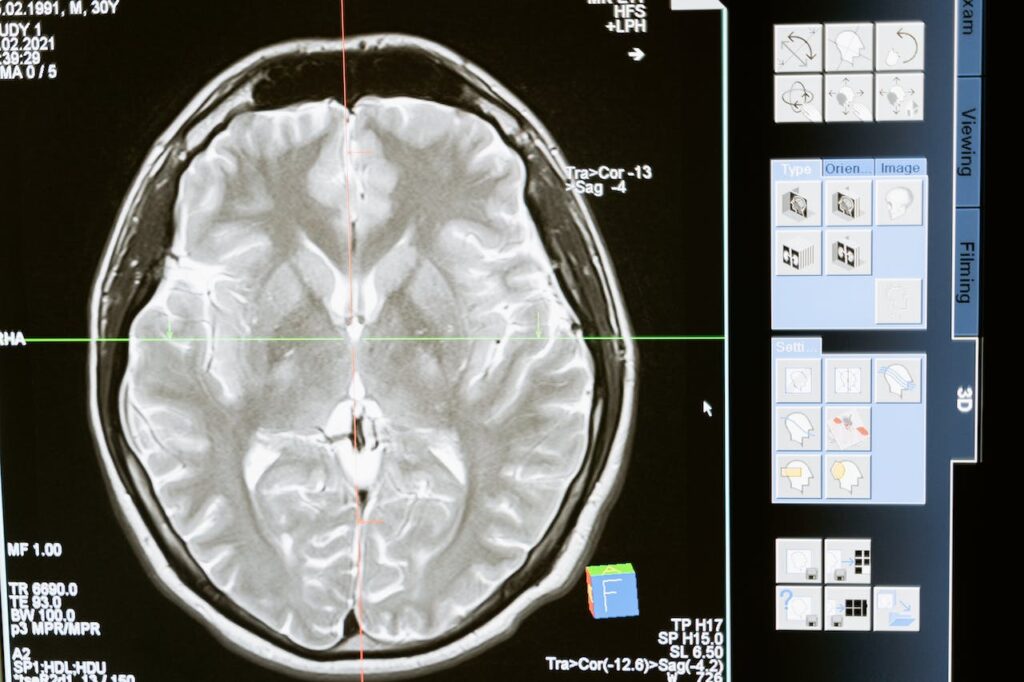脳診断の画像